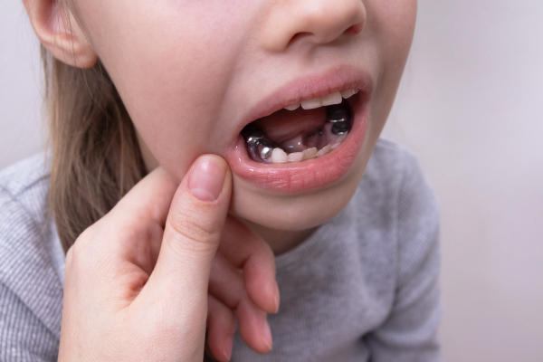 Choosing Between Kids Dental Crowns And Veneers